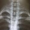 Иркутские врачи спасли подростка, который проглотил иголку от шприца